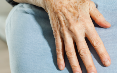 Rejuvenescimento das mãos: Conheça o método para tratar o envelhecimento.